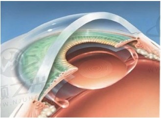 60岁高度近视能做晶体植入吗?看看患者的案例分享