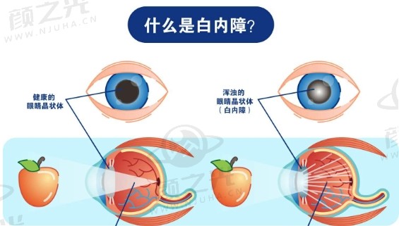 导致白内障的原因有哪些?如何防止白内障早发生?