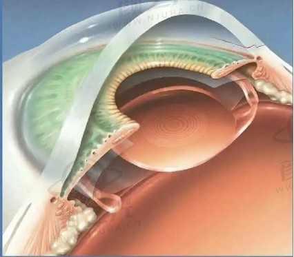 人工晶体植入术效果维持多久？专家解读持久视力保障