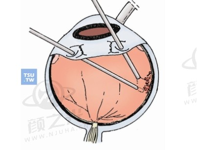 明亮重生：探秘现代眼科技术下的视网膜脱离手术奇迹