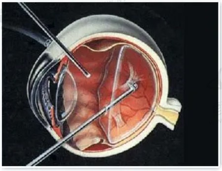 明亮未来的眼界：玻璃体视网膜手术的微创革新