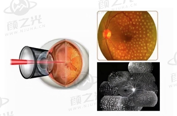 光明之旅：视网膜激光治疗点亮视野的医学奇迹