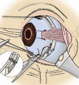 透明视界的奇迹：探秘环切巩膜手术的眼科革新