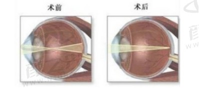 透视清晰未来：探索现代眼科艺术——角膜屈光手术