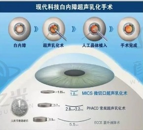 现代医学新篇章：激光辅助白内障手术引领个性化眼科治疗时代