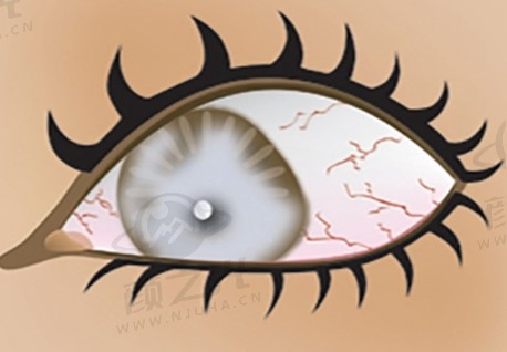 青光眼的症状和表现是什么？应该怎样治疗