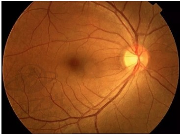 艾维眼科医院专家何雨檀提醒：糖尿病患者务必定期检查眼底，保护视力健康！