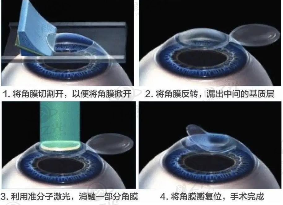 准分子激光