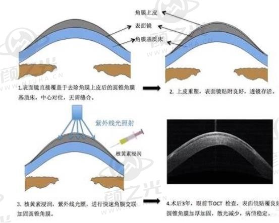角膜交联术3