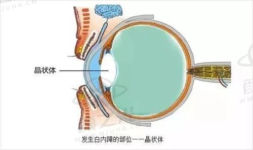 陪奶奶在郑州尖峰眼科医院做了白内障手术，刘保松院长技术真的好