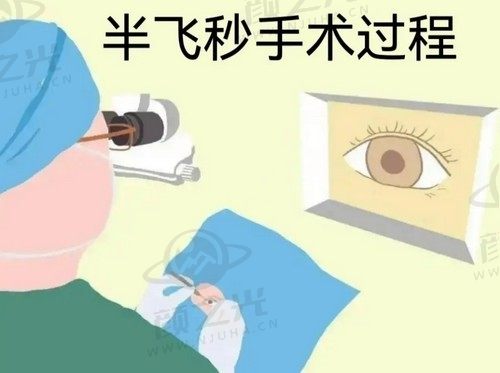 王华医生近视手术失败的很少，在长沙裕湘眼科做半飞Q+13800起