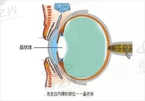 ​福州亮睛眼科医院白内障手术免费吗？揭秘真实情况，看看骨干医生怎么说！