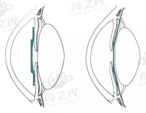 上海新视界眼科医院收费标准是怎样的？