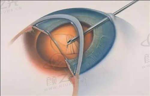 杭州爱尔眼科医院白内障手术