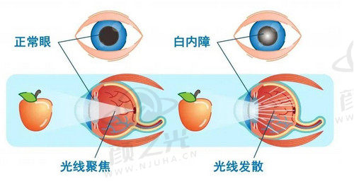 陈春林医生做白内障手术的口碑好