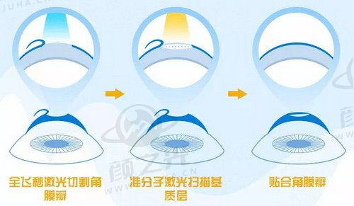 哈尔滨爱尔眼科医院张焱医生做全飞秒近视手术价格实惠