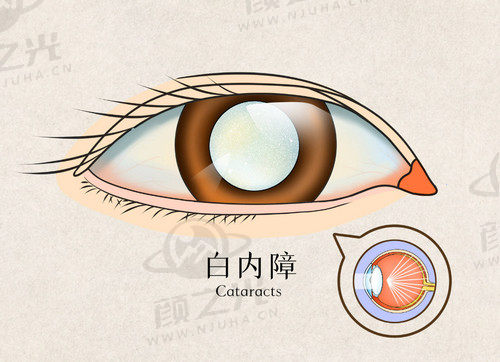 郑州尖峰眼科医院刘保松的白内障手术技术高超