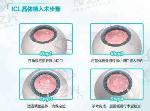 北京民众眼科医院朱思泉医生做晶体植入手术技术娴熟