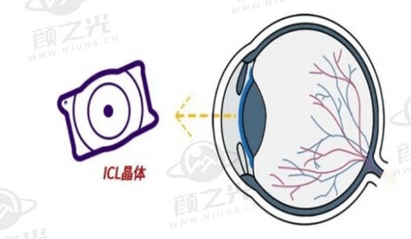 泉州华厦眼科医院ICL晶体植入术怎么样？