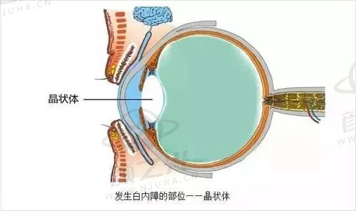 郑州尖峰眼科医院白内障病变位置