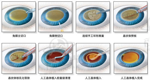 郑州尖峰眼科医院刘保松为奶奶制定白内障超声乳化手术