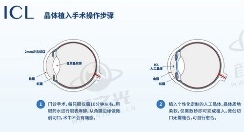 北京维视眼科医院罗岩做icl手术技术成熟