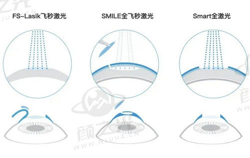 邓应平眼科医生做近视手术技术娴熟