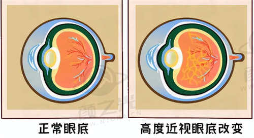 天津华厦眼科医院全飞秒近视手术技术优势分析