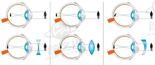 长春爱尔眼科准分子激光手术价格