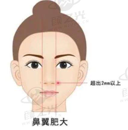鼻翼缩小术.jpg