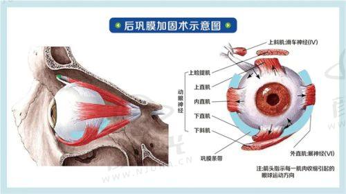 天津华厦眼科怎么样？全飞秒手术18000元起，专家团队保驾护航！