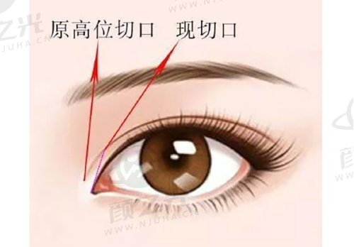 成都看疤痕疙瘩，揭秘华西及省医院五位排名靠前医生的资历、疗法与显著效果！ 