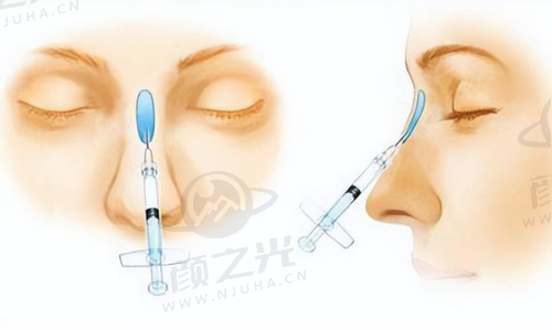 江西假体隆鼻手术排名前十医院大揭秘，各院优势、医生技术全解析！ 
