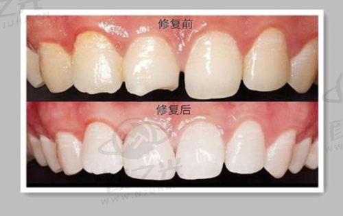 四、杭州美奥口腔医院种植牙总结