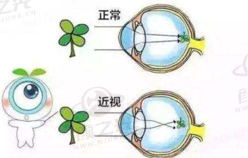 五、昭通艾维眼科医院视力矫正项目