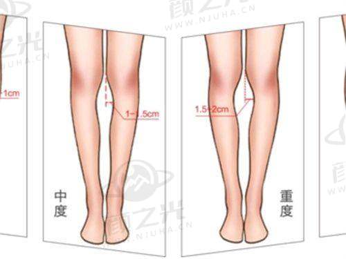 五、深圳曹孟君医疗美容——高端假体隆胸体验