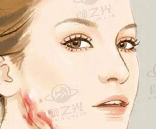 二、大连爱德丽格刘志刚之凹陷眼修复实例