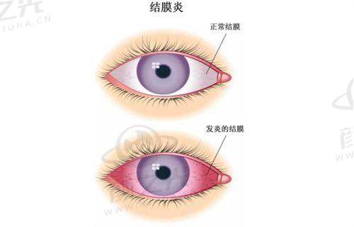 四、兰州普瑞眼科医院近视眼手术价格揭秘