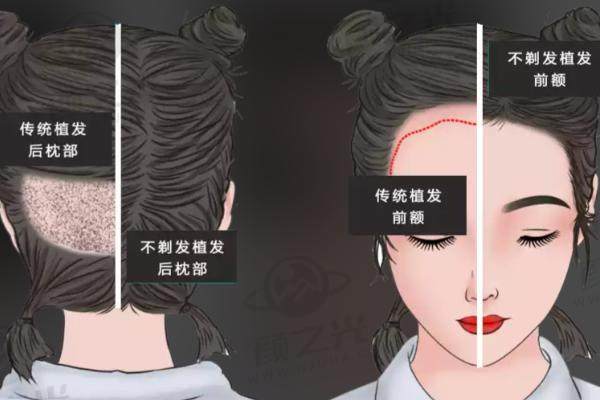 九、广州碧莲盛植发资讯攻略引导