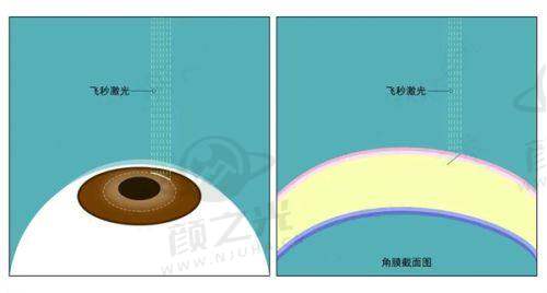 五、兰州普瑞眼科医院温馨提示