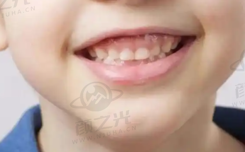 赤峰欢乐口腔是公立私立？私立连锁资质可靠，种植牙2500元起，附2025价格表 