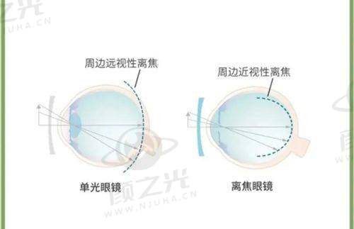 佛山华厦眼科医院：多样手术技术满足不同需求