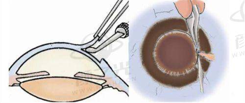 深圳深西爱尔眼科医院全解析:2025 近视矫正价格 + 专精医生团队,地址 & 口碑一览!