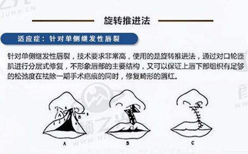 新疆威兹曼美容医院法令纹怎么解决？日常护理 + 医美手段全方案揭秘！ 