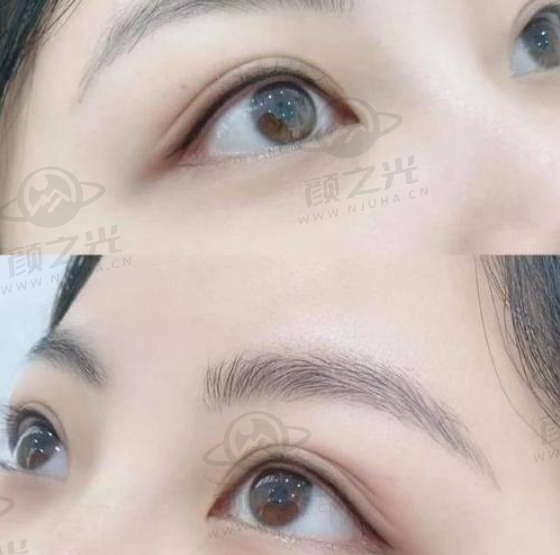 鼻子整形项目：打造精致美鼻