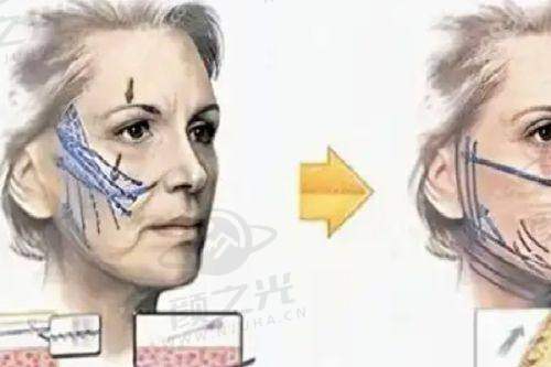 杭州天鑫整形医院双眼皮技术精良吗?