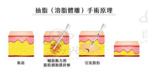 北京艺美王东院长王东：十余年脂肪整形经验，“三线九点法+衔接性吸脂”塑造自然美感，深受求美者信赖
