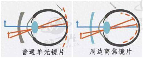 商丘普明眼科医院精良设备助力