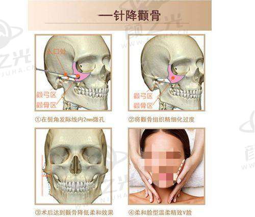 郑州丽天罗明生吸脂技术揭秘：实例多、效果好、价格优，助你打造完美身材！ 
