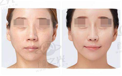 深圳美莱整形医院价格表公布？眼部、胸部等项目价格透明，无“套路” 